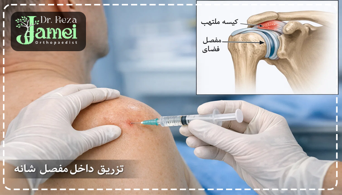 تزریق داخل مفصل شانه