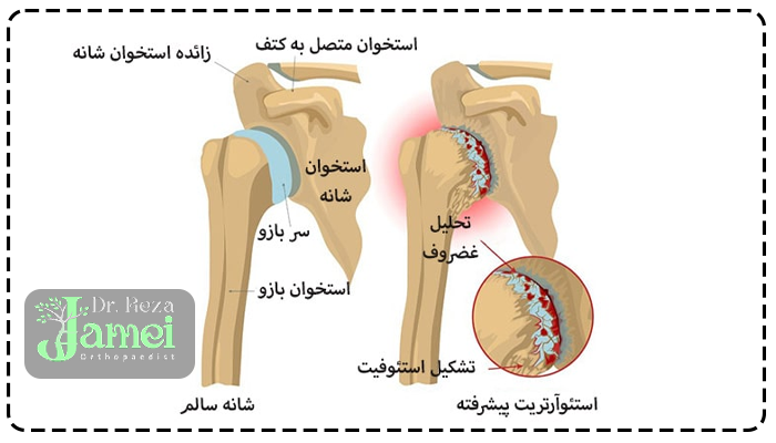 تشخیص آرتروز شانه