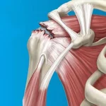 تمرینات ورزشی پارگی ناقص تاندون روتاتور کاف