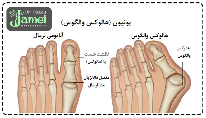 هالوکس والگوس چیست
