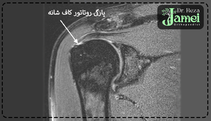 پاره شدن روتاتور کاف شانه