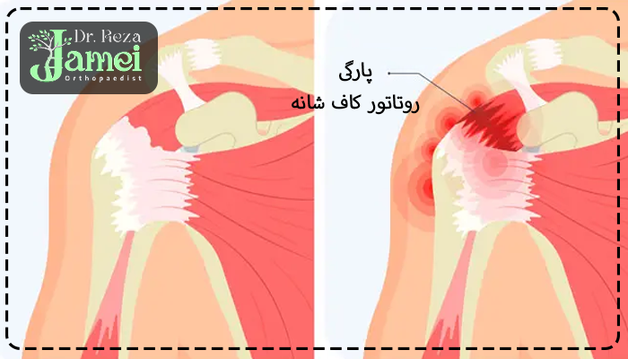 پارگی روتاتور کاف شانه