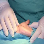جراحی تونل کارپال