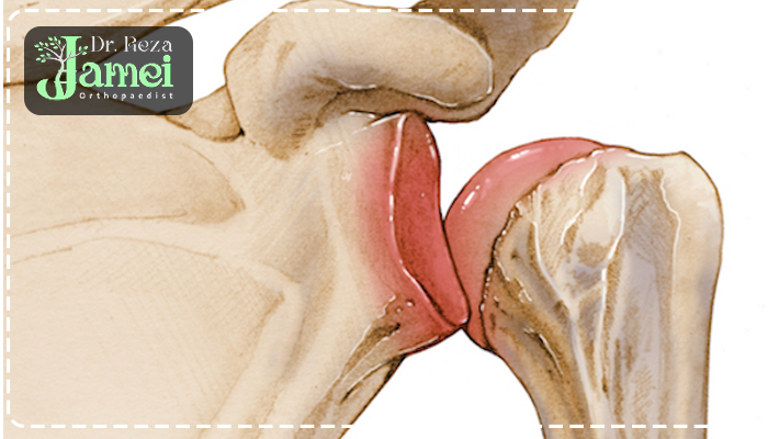علت در رفتگی مکرر شانه
