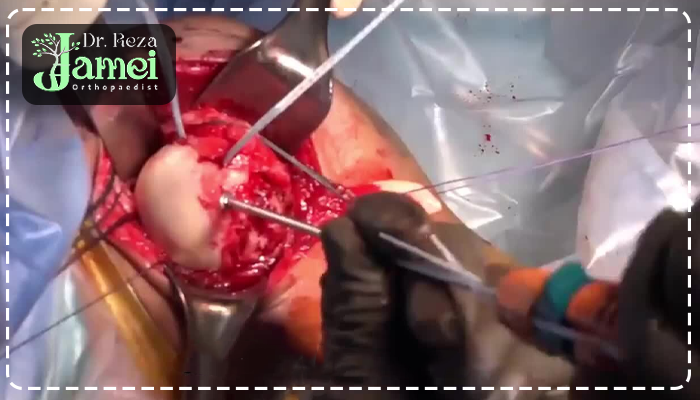 جراحی باز روتاتور کاف شانه